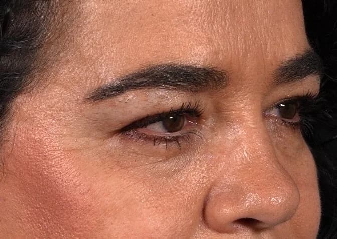 Mirada antes de la blefaroplastia superior, con exceso de piel en el párpado superior