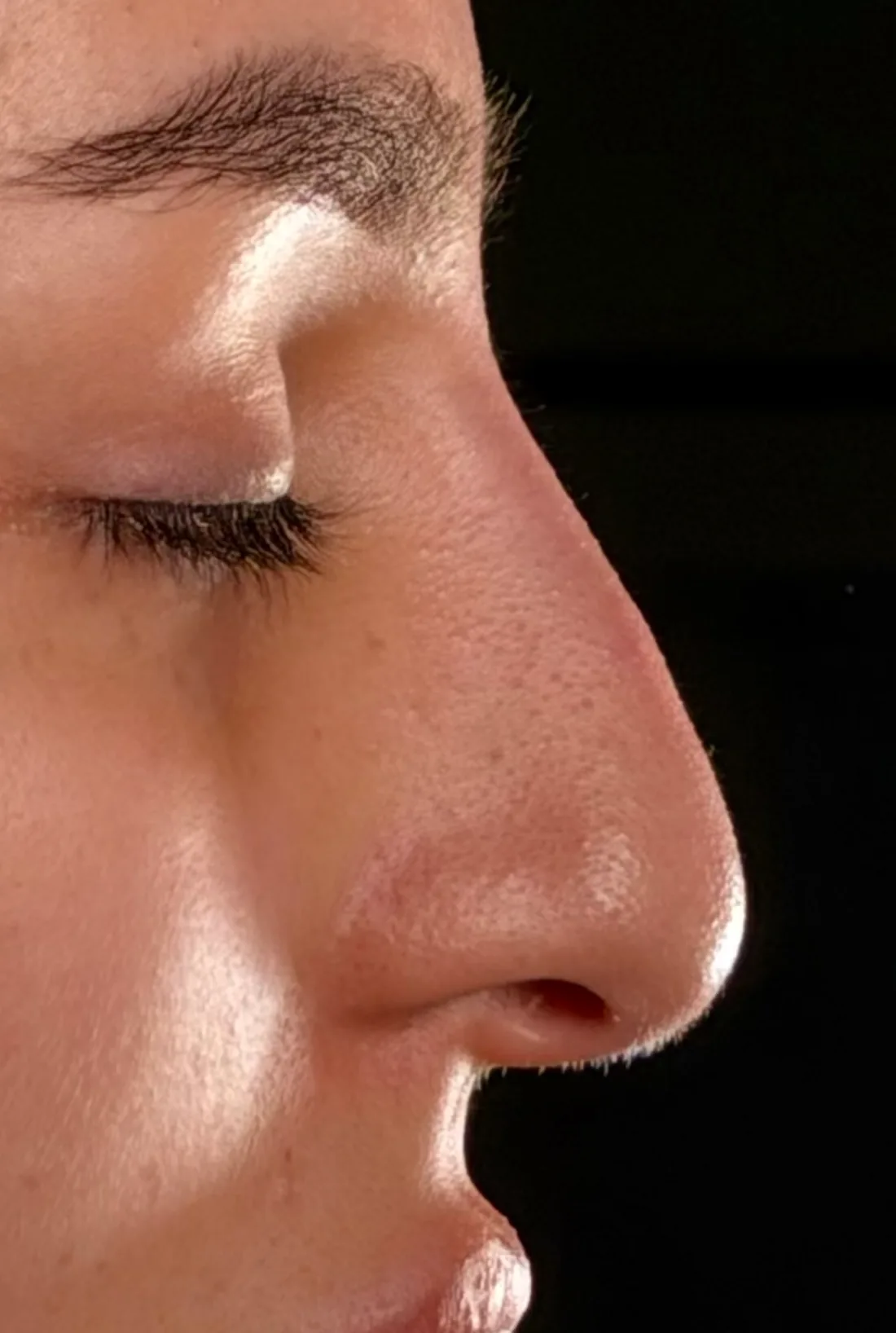 Perfil de una nariz antes de la rinoplastia, con una pequeña giba en el dorso y la punta algo descendida