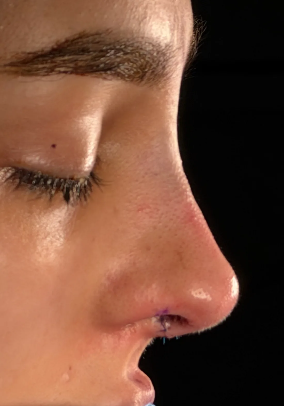 Perfil de la misma nariz después de la rinoplastia, con el dorso más recto y la punta más definida y elevada