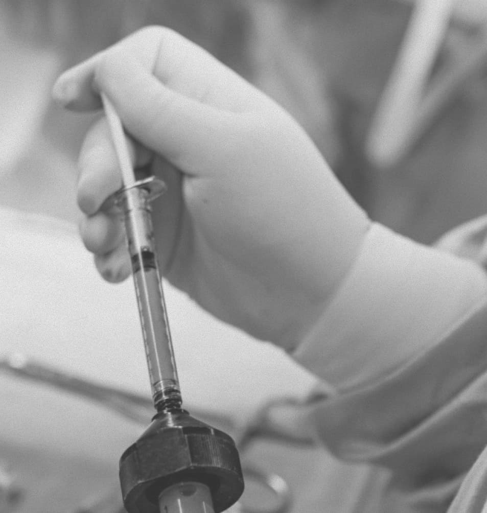 Jeringa con grasa autóloga para lipofilling periorbitario