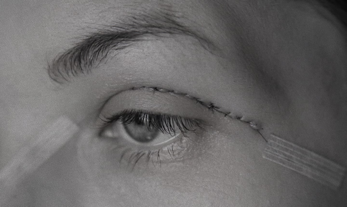 Párpado superior con suturas de blefaroplastia en el postoperatorio