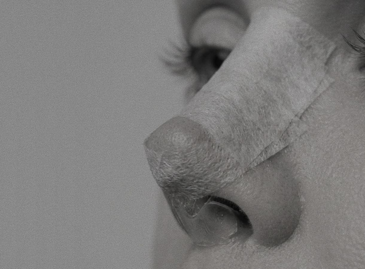 Nariz con férula de rinoplastia en el postoperatorio