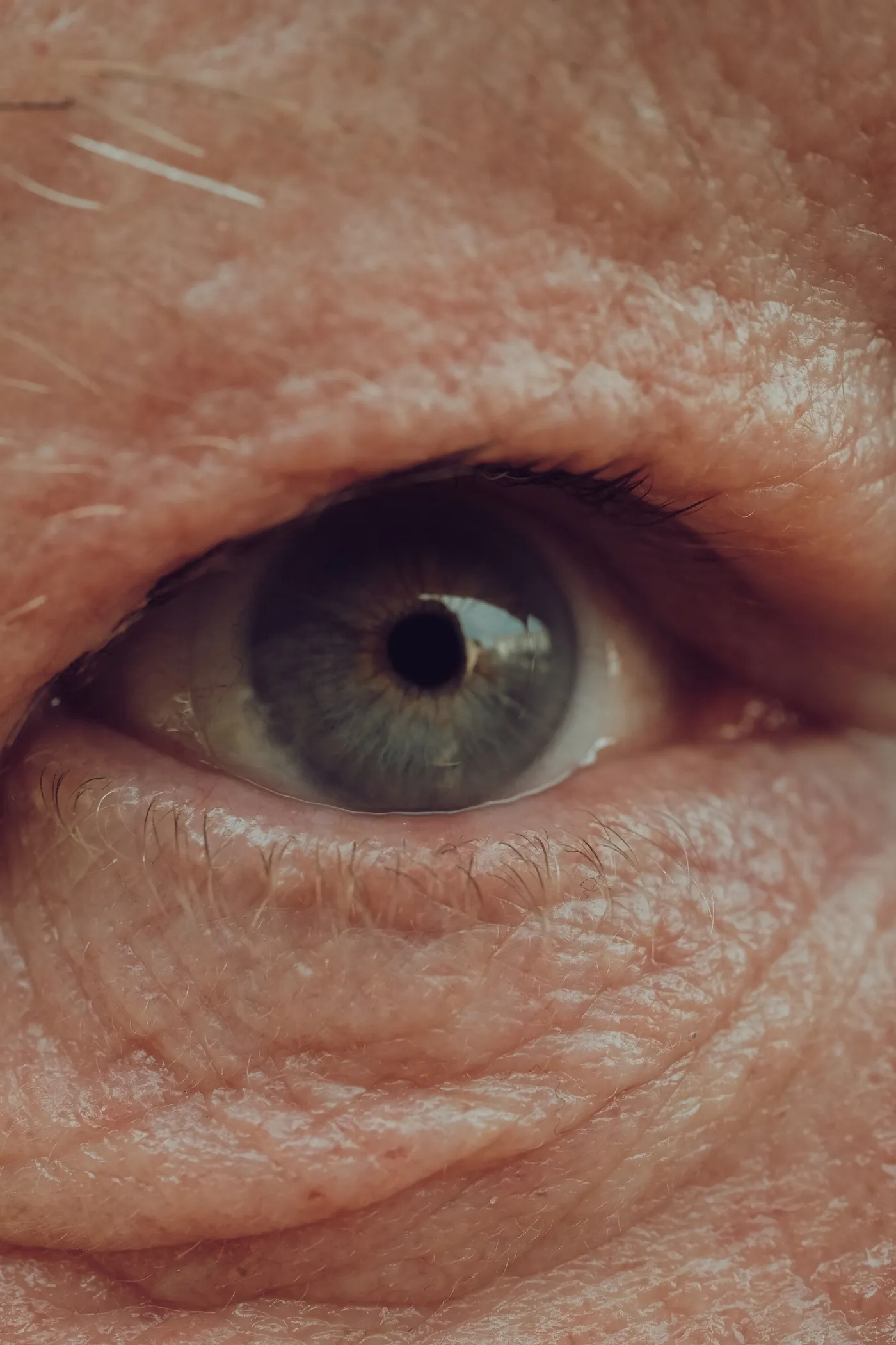 Detalle de un ojo con el párpado superior caído por exceso de piel